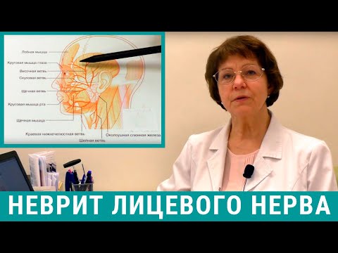 Видео: Неврит лицевого нерва: лечение причины