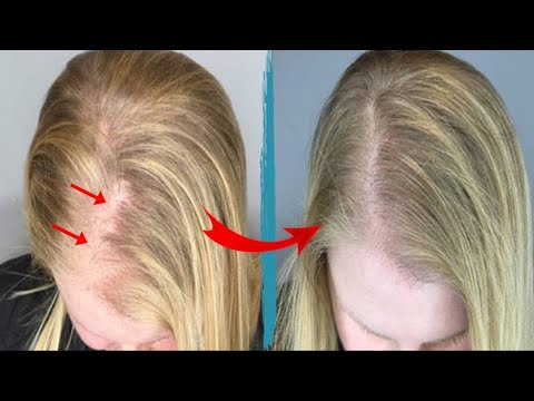 Видео: Это Действительно Может Помочь Вам При Выпадении Волос. Вы Должны Знать Это - Доктор Вивек Джоши