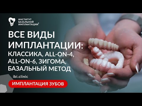 Видео: Виды имплантации зубов: Классика, All-on-4, All-on-6, Скуловая имплантация, Базальный метод.