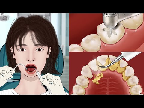 Видео: ASMR Стоматологическая анимация🦷Удовлетворительное удаление зубного камня и кариеса
