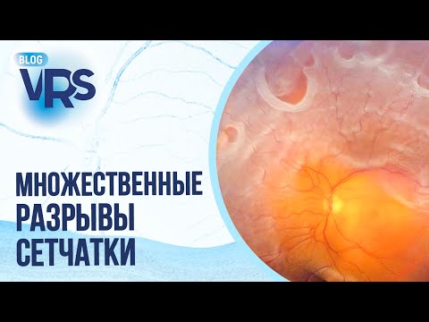 Видео: Множественные разрывы сетчатки | Отслойка сетчатки