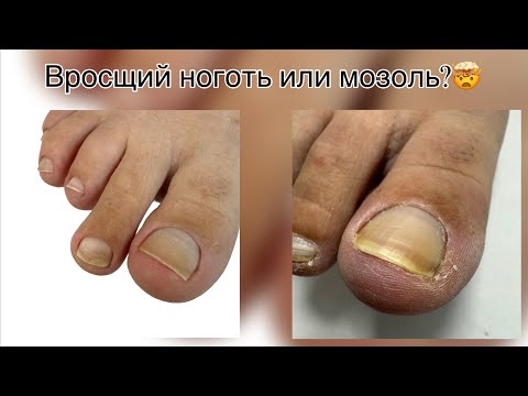 Видео: Аппаратный педикюр, вросший ноготь, мозоли