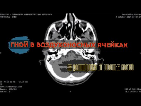 Видео: ДВУХСТОРОННИЙ МАСТОИДИТ (гной в воздухоносных ячейках) на РАСШИФРОВКЕ КТ височных костей