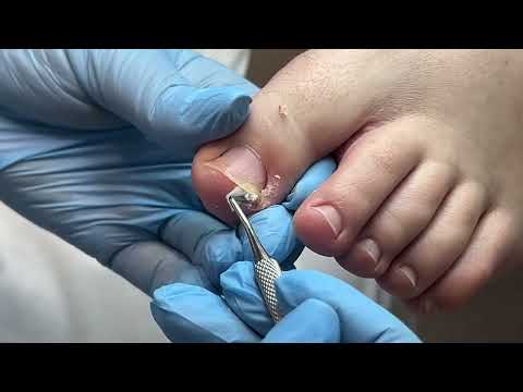 Видео: Работа с вросшим ногтем | Воспаление | Отек | Тампонада