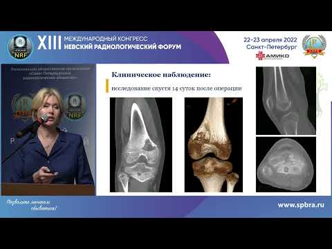 Видео: КОНУСНО–ЛУЧЕВАЯ КОМПЬЮТЕРНАЯ ТОМОГРАФИЯ В ПЕДИАТРИИ. ВОЗМОЖНОСТИ СЕГОДНЯ