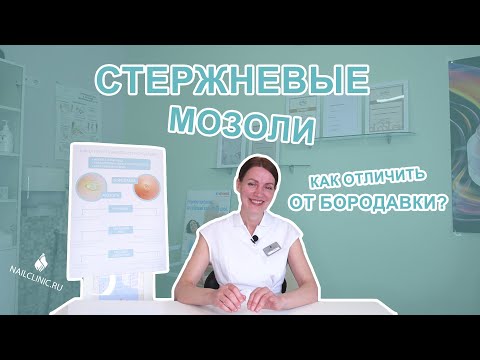 Видео: Стержневая мозоль. Удаление стержневой мозоли.