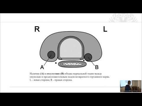 Видео: Папиллярная микрокарцинома щитовидной железы – тактика лечения