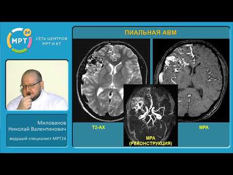 Видео: Ангиодисплазия головного мозга