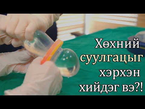 Видео: [ Хөхний мэс заслын жинхэнэ суулгац UNBOXING! ] Суулгацыг хэрхэн хийдэг вэ? / Mentor Memory Gel