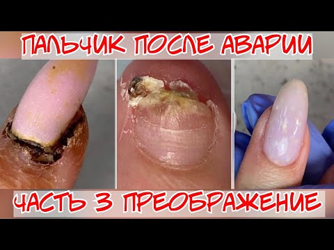 Видео: Преображение 3❤️ Восстановление ногтя после травмы 🔥 Финал 🔥 наращивание ногтей гелем