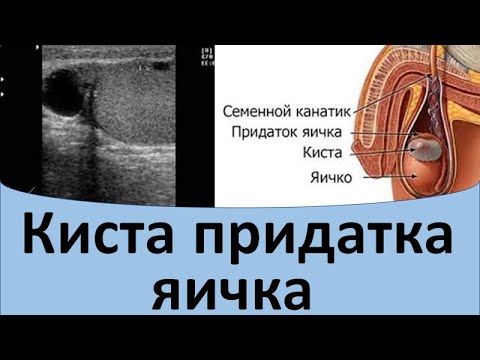 Видео: Киста придатка яичка