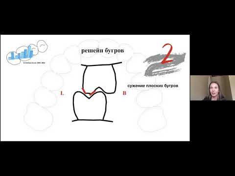 Видео: Webinar 2: Окклюзионная эквилибрация и Пришлифовывание контактов по данным Т-скан. Высота прикуса.