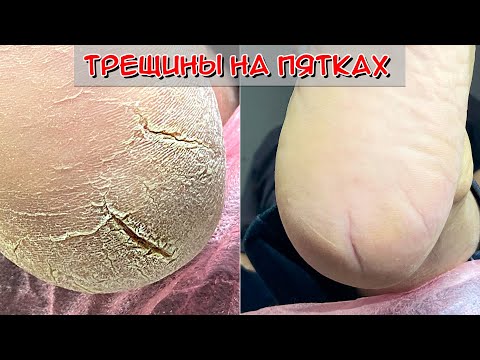 Видео: Трещины на пятках /Грибок на ногах