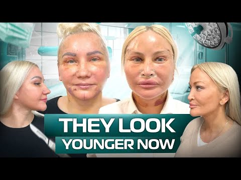 Видео: Подтяжка лица в Турции: результаты наших пациенток спустя год - вы удивитесь!