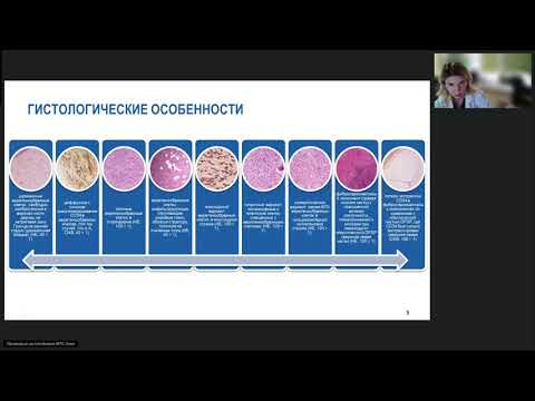 Видео: Редкие опухоли  Дерматофибросаркома (вебинар 16 октября 2024)