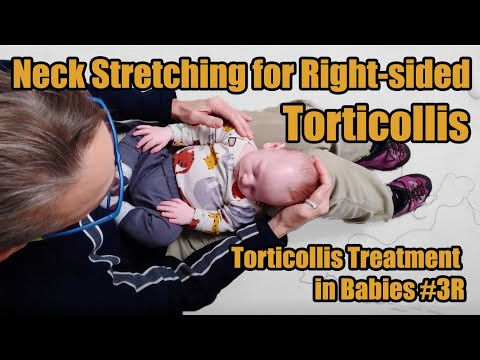 Видео: # 3R Растяжка шеи при правостороннем тортиколлисе: лечение тортиколлиса у младенцев