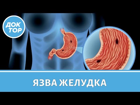 Видео: Как не допустить язвы желудка