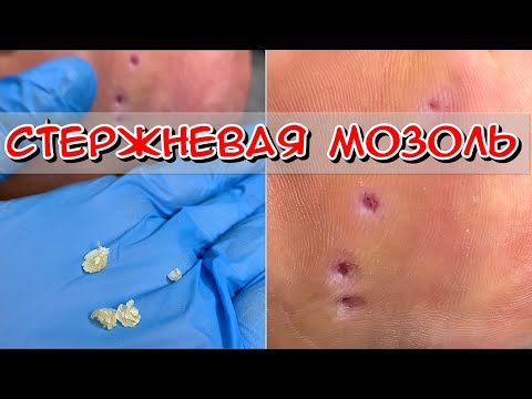 Видео: Стержневая мозоль на стопе / Удаление стержневой мозоли / Как избавиться от стержневой мозоли