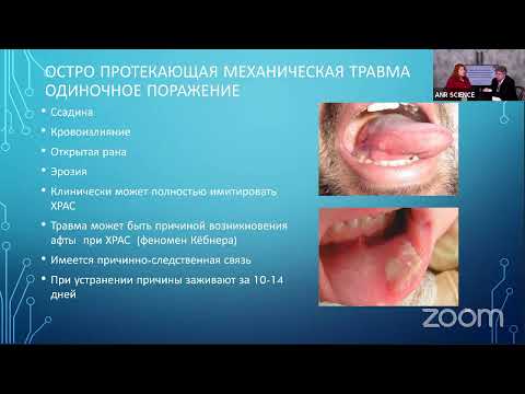 Видео: Хронический рецидивирующий афтозный стоматит