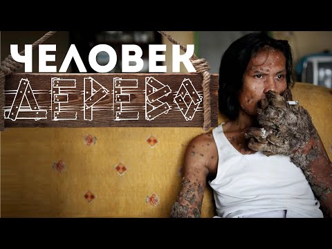 Видео: Человек-дерево | Самая странная болезнь