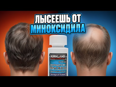 Видео: ПОЧЕМУ ТЫ ОБЛЫСЕЕШЬ ОТ МИНОКСИДИЛА?