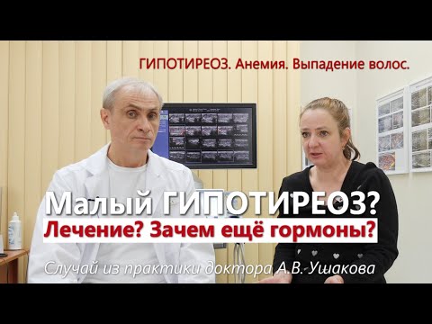 Видео: Гипотиреоз. Лечение? Без гормонов? Анемия. Выпадение волос. УЗИ щитовидной железы // Доктор Ушаков