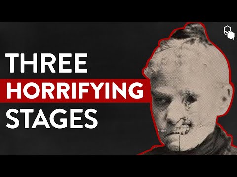 Видео: Три ужасающие стадии сифилиса