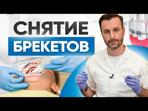 Видео: Снятие брекетов на реальном примере! Что делать после того как сняли брекеты?