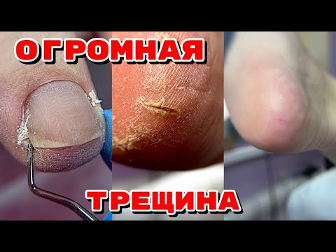 Видео: ТРЕЩИНА НА ПЯТКЕ 😥 Огромная подногтевая мозоль 🦶 Педикюр после зимы