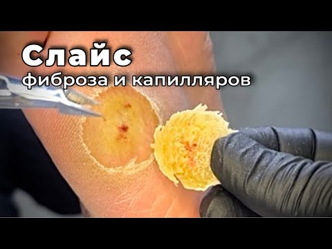 Видео: Сплетение кожных структур. Мозоль гигант