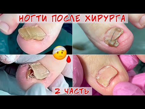 Видео: Ногти после удаления у хирурга 🤯 Часть 2 / Протезирование ногтей