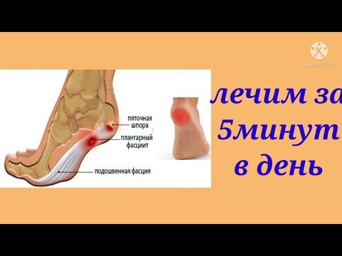 Видео: Упражнения для лечения пяточной шпоры