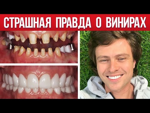 Видео: ГОЛЛИВУДСКАЯ УЛЫБКА: как делают виниры, сколько это стоит и стоит ли овчинка выделки?