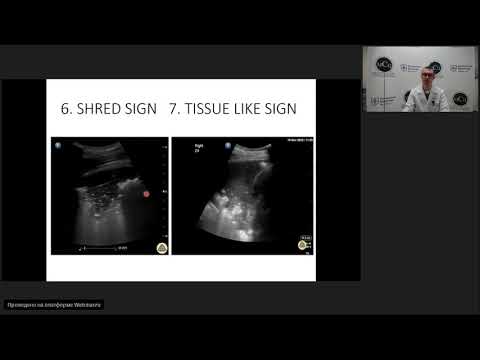 Видео: Ультразвуковые критерии синдрома консолидации. Протокол ультразвукового сканирования легких