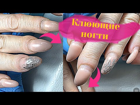 Видео: ТРЕШ| Дистрофия😱|Как поднять КЛЮЮЩИЙ НОГОТЬ без акригеля|Коррекция Замесом|Преображение Ногтей