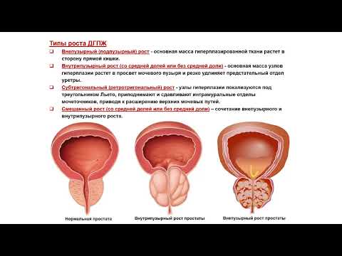 Видео: УЗИ. Доктор Иогансен. Выпуск 116.  Доброкачественная гиперплазия предстательной железы. Часть 2.