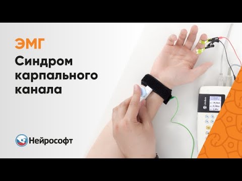 Видео: ЭМГ: Диагностика Карпального Туннельного Синдрома (Синдром Запястного Канала)