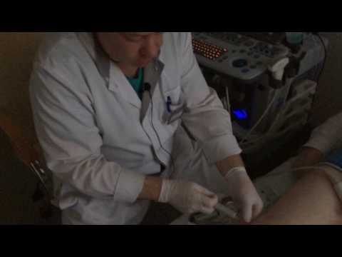 Видео: Псориатический артрит. Чего не видно на МРТ? УЗИ во время инъекции