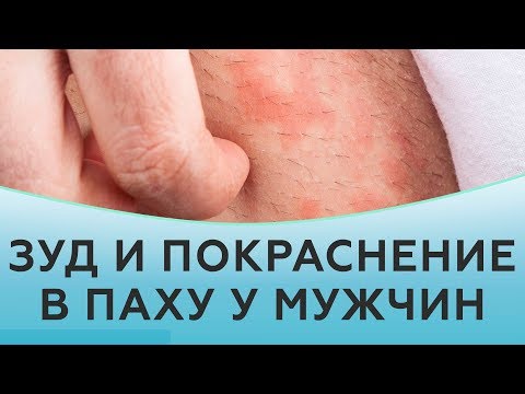 Видео: Зуд и покраснение в паху у мужчин