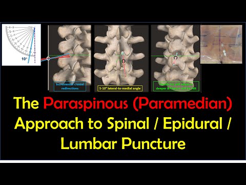 Видео: Парамедиальный (парамедиальный) доступ к спинальной и эпидуральной анестезии и лапароскопической ...