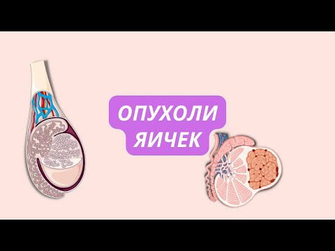 Видео: Опухоли яичек 🥜 разновидности, как распознать и как отличить?