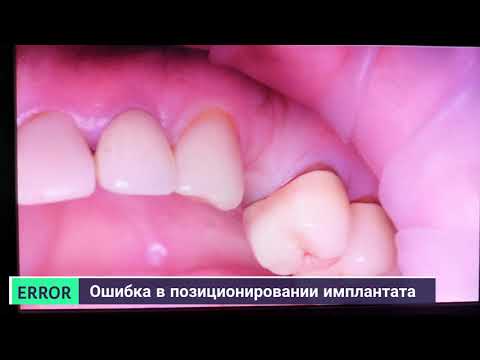 Видео: Ошибка в позиционировании имплантата и тактика принятия решения featuring Dr.Korovkin 4K