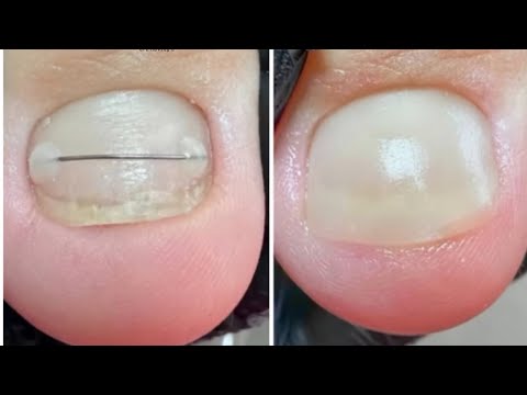 Видео: ПРОТЕЗИРОВАНИЕ НОГТЕЙ НА НОГАХ
