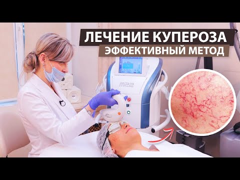 Видео: Лечение купероза самым эффективным методом