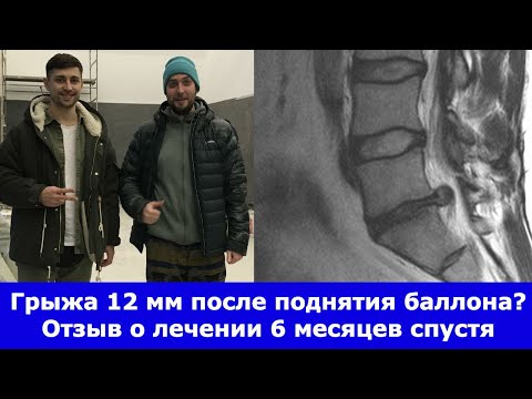 Видео: Грыжа 12 мм уменьшилась в 2 раза за 6 месяцев. Отзыв о лечении