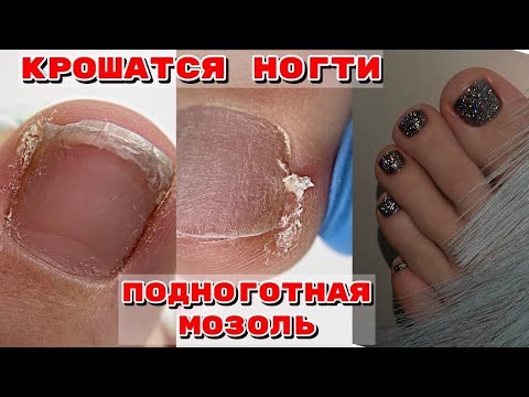 Видео: КРОШАТСЯ НОГТИ  🤪 Что делать 💅Убираем подногтевые мозоли 💅 Педикюр