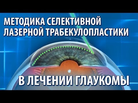 Видео: Методика селективной лазерной  в лечении глаукомы