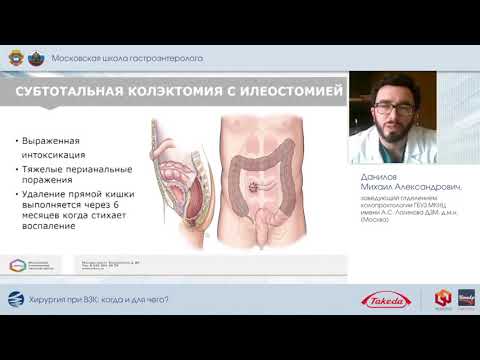 Видео: Хирургия при ВЗК: когда и для чего?