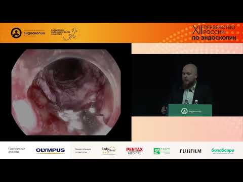 Видео: Случай успешного лечения больного с рубцовым стенозом верхней трети пищевода и глотки