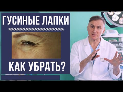 Видео: ❗️👍КАК УБРАТЬ ГУСИНЫЕ ЛАПКИ? ПРОЦЕДУРЫ И ПЛАСТИКА